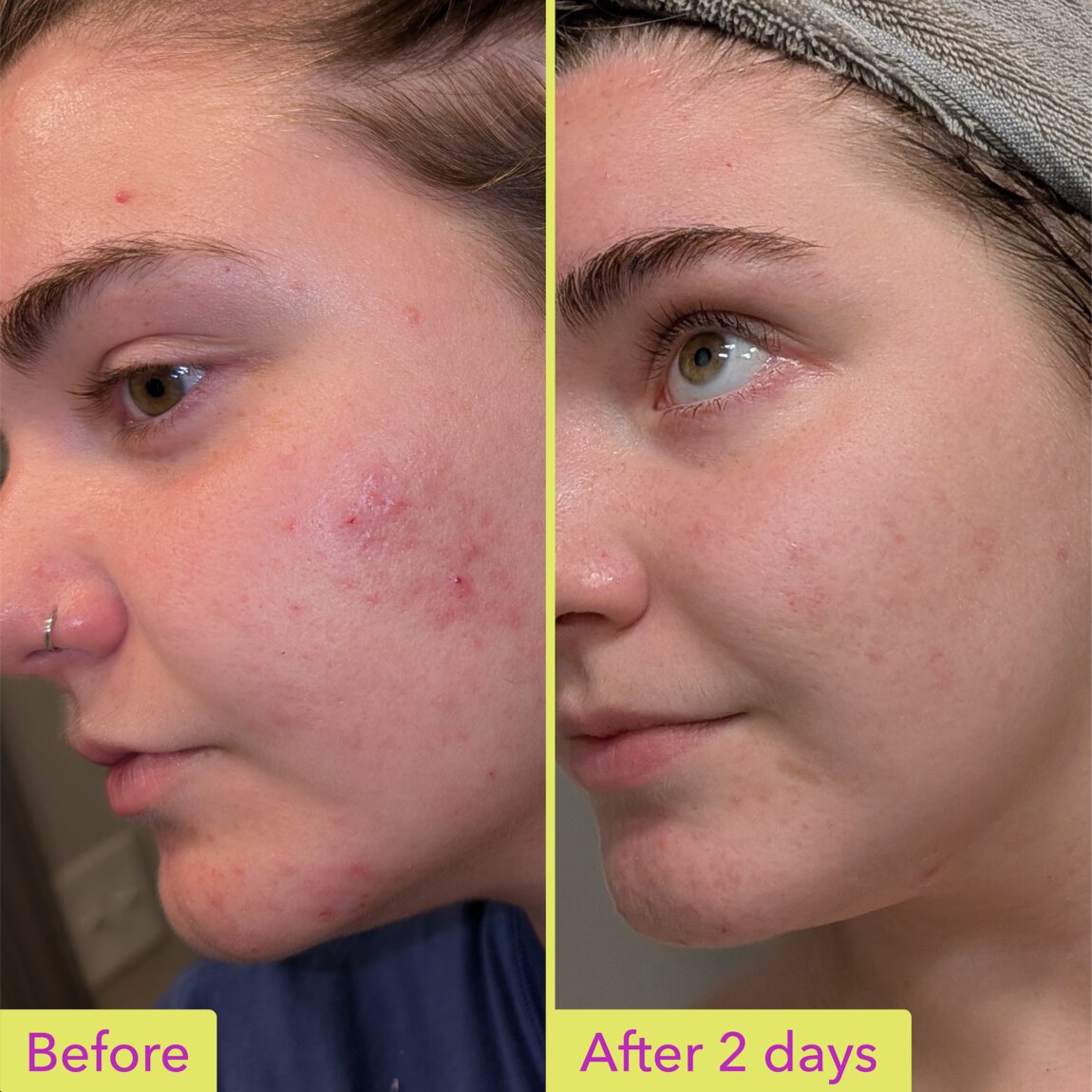 10-azelaic-acid-treatment-f0 zb_p.jpg