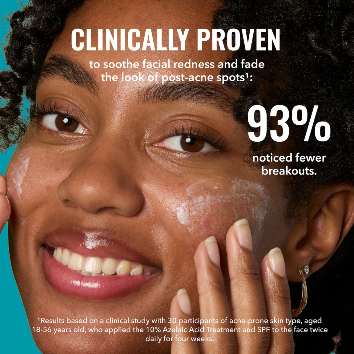 10-azelaic-acid-treatment-f0 zb_p.jpg