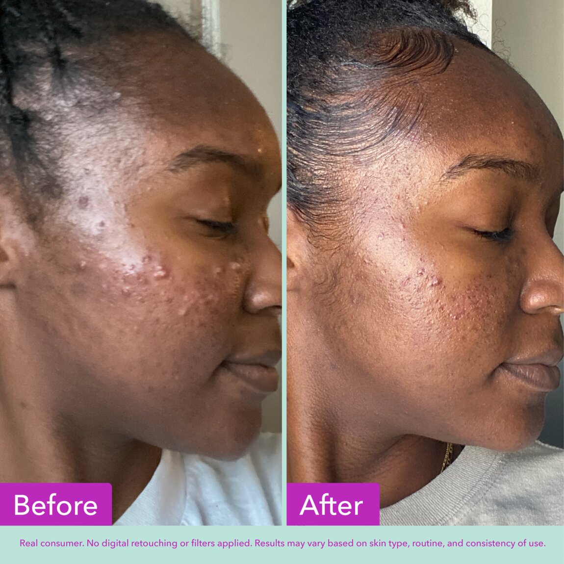 acne-foaming-cleanser-b4 zb_p.jpg