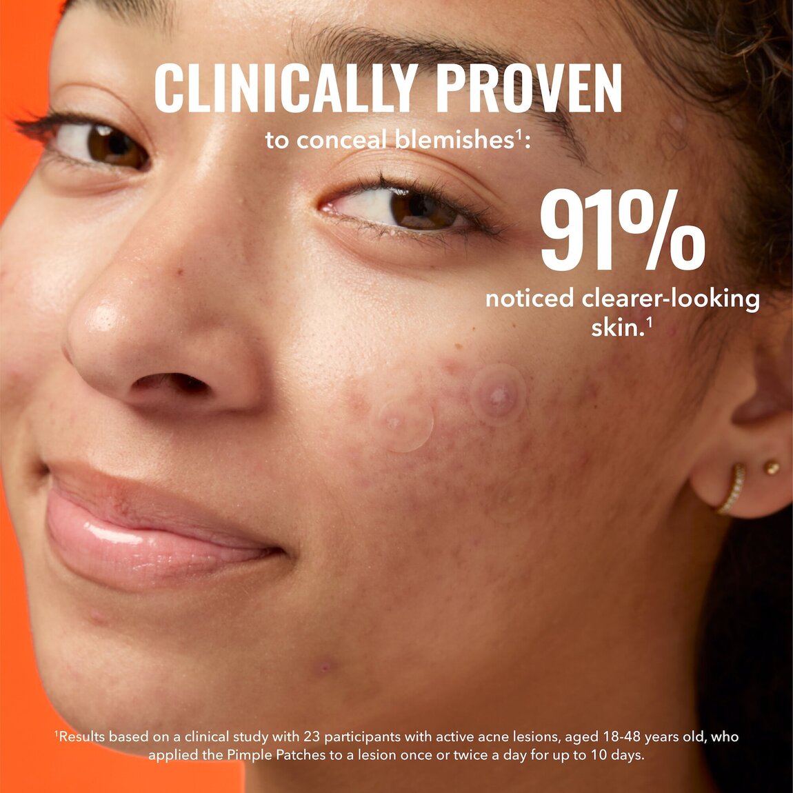 pimple-patches-s4 zb_p.jpg